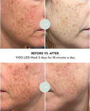 VISO - FDA Certified Red Light Therapy Mask